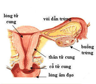 Lạc nội mạc tử cung có thể gây vô sinh ở phụ nữ