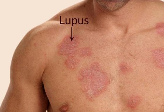 Lupus đỏ là bệnh thường gặp ở phụ nữ và có thể sảy ra ở nam giới