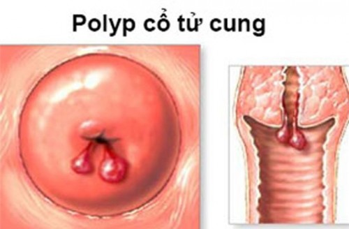 Polyp cổ tử cung gây chảy máu phải làm sao