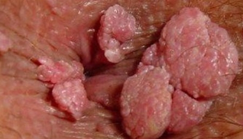 Sùi mào gà xuất hiện ở miệng hoặc ở vùng cơ quan sinh dục