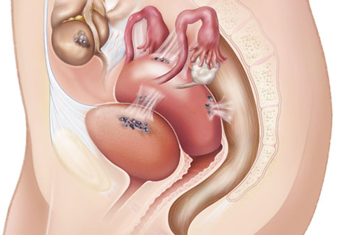 Viêm nội mạc tử cung là bệnh lý khó phát hiện sớm