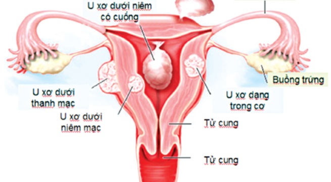 U xơ tử cung không được điều trị kịp thời phải cắt bỏ tử cung