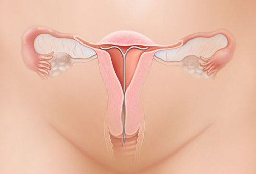 Đặt vòng tránh thai và những điều chị em nên biết (1)