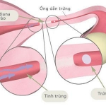 Tắc ống dẫn trứng và phương pháp khắc phục