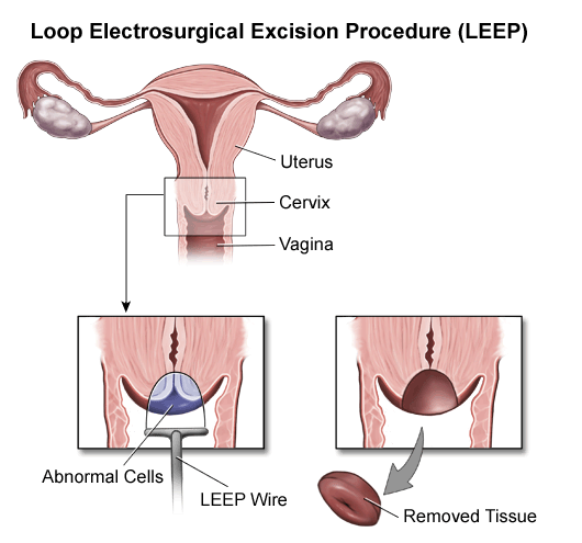 Điều trị ung thư cổ tử cung bằng phương pháp phẫu thuật LEEP