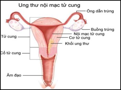Các phương pháp điều trị ung thư nội mạc tử cung