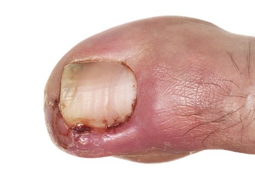 Ngón cái sưng phồng và đau có thể là do bệnh Gout