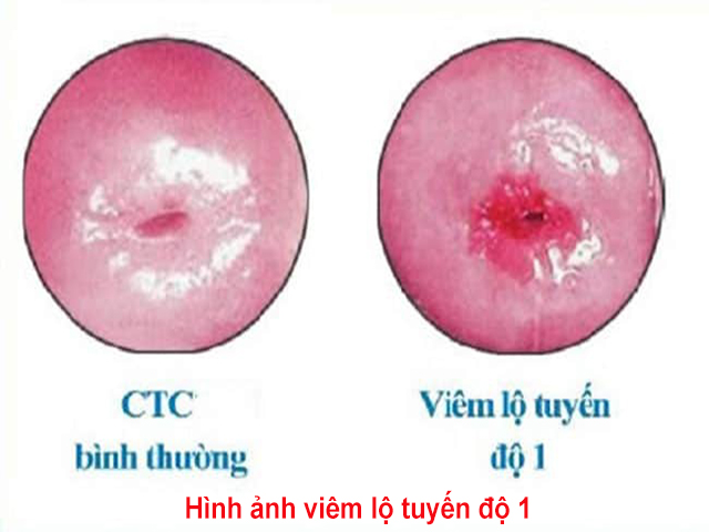 hình ảnh viêm lộ tuyến cổ tử cung độ 1