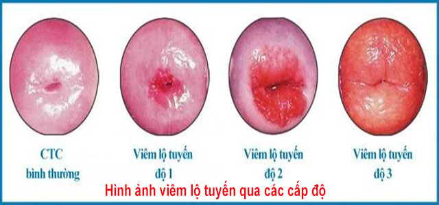 Hình ảnh viêm lộ tuyến qua các cấp độ