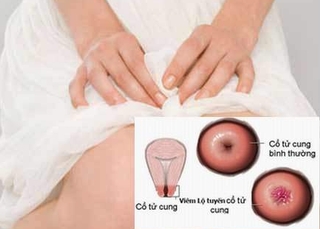 ĐIều trị viêm lộ tuyến cổ tử cung hiệu quả để tránh vô sinh