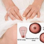 Điều trị viêm lộ tuyến cổ tử cung ở phụ nữ (1)