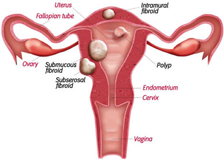 Một trong các căn bệnh thường gặp ở chị em phụ nữ là polyp tử cung 