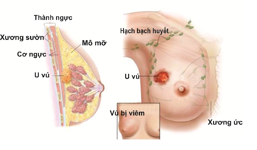 U xơ tuyến vú là căn bệnh xuất hiện khi trong cơ thể, kích thích tố hoạt động một cách bất thường