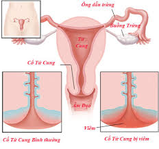 Viêm lộ tuyến cổ tử cung nhẹ (1)