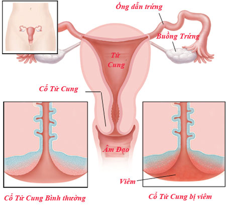 Viêm lộ tuyến cổ tử cung là tình trạng các tế bào tuyến bình thường nằm trong ống cổ tử cung
